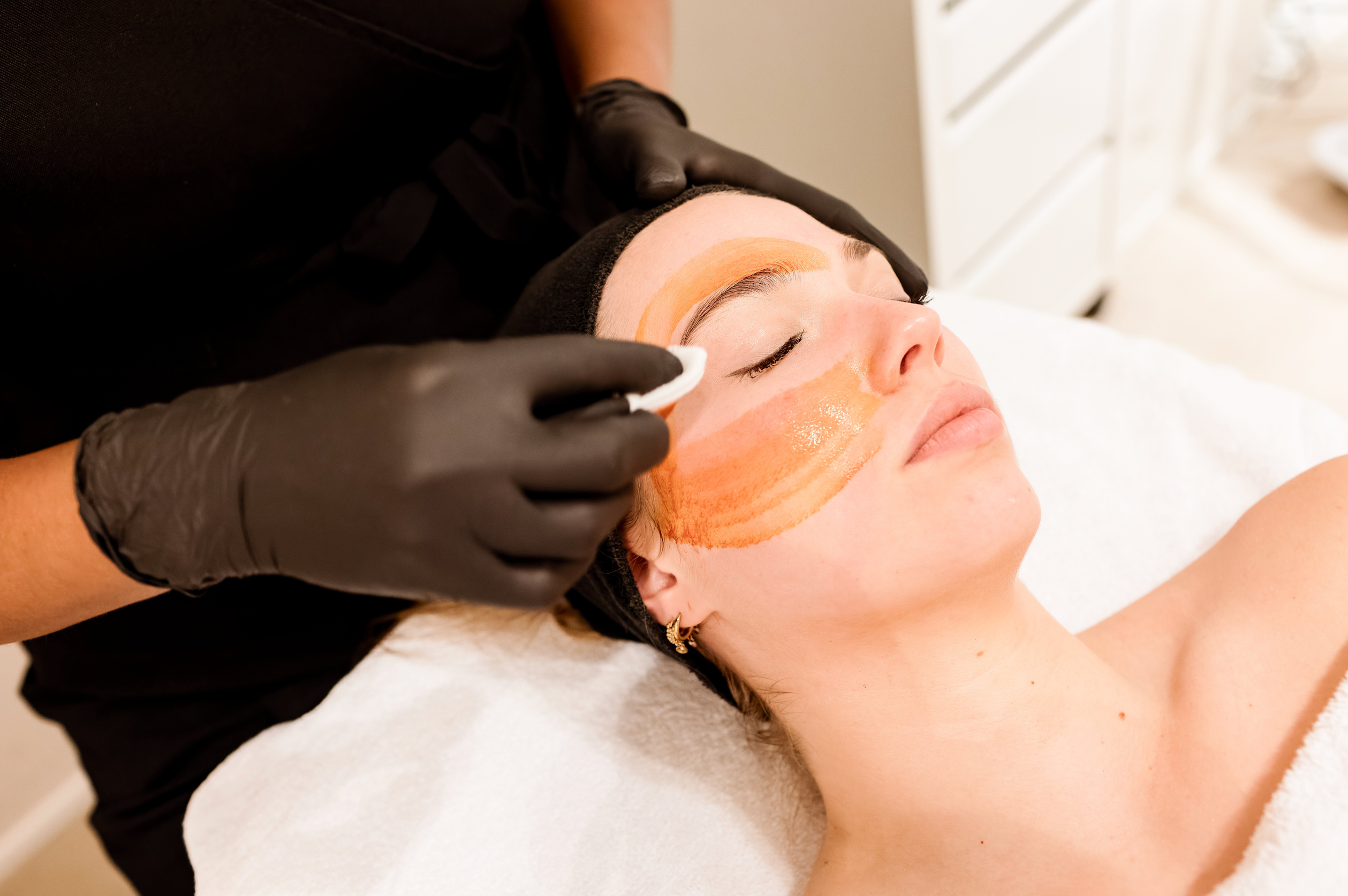 Chemische Peeling Skin Clinic Rotterdam