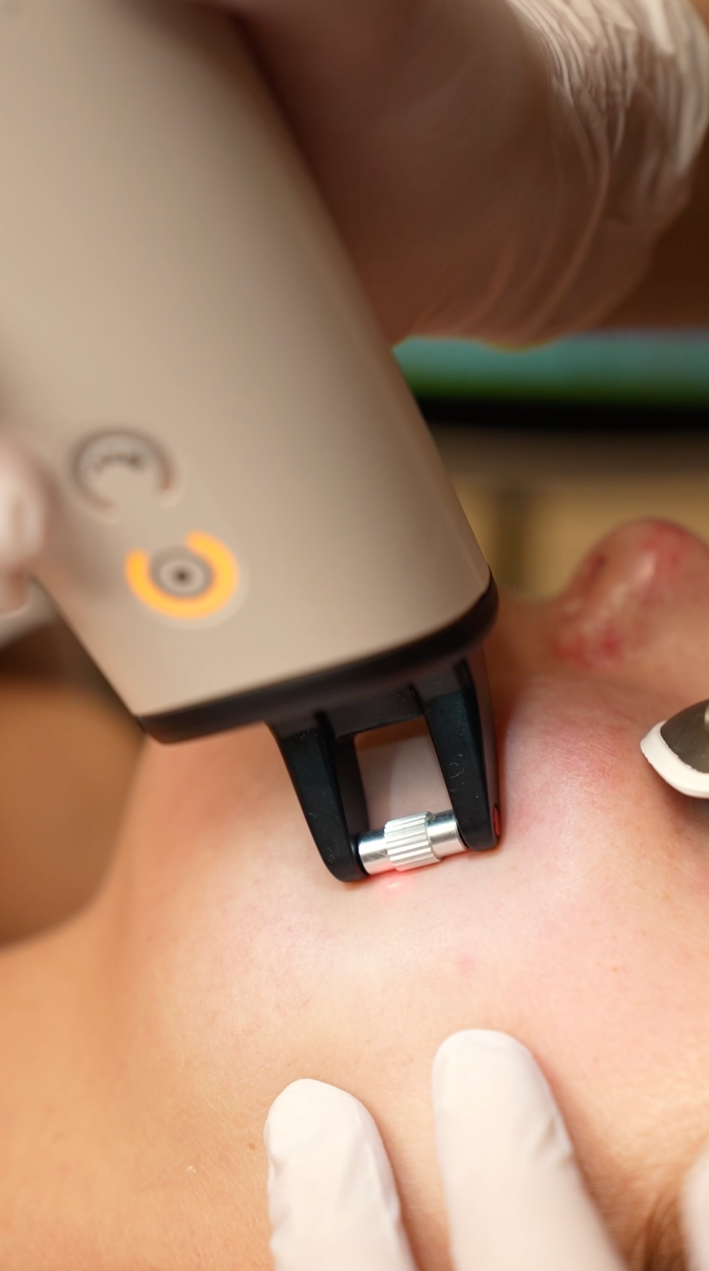 Fractionele laser Skin Clinic Rotterdam