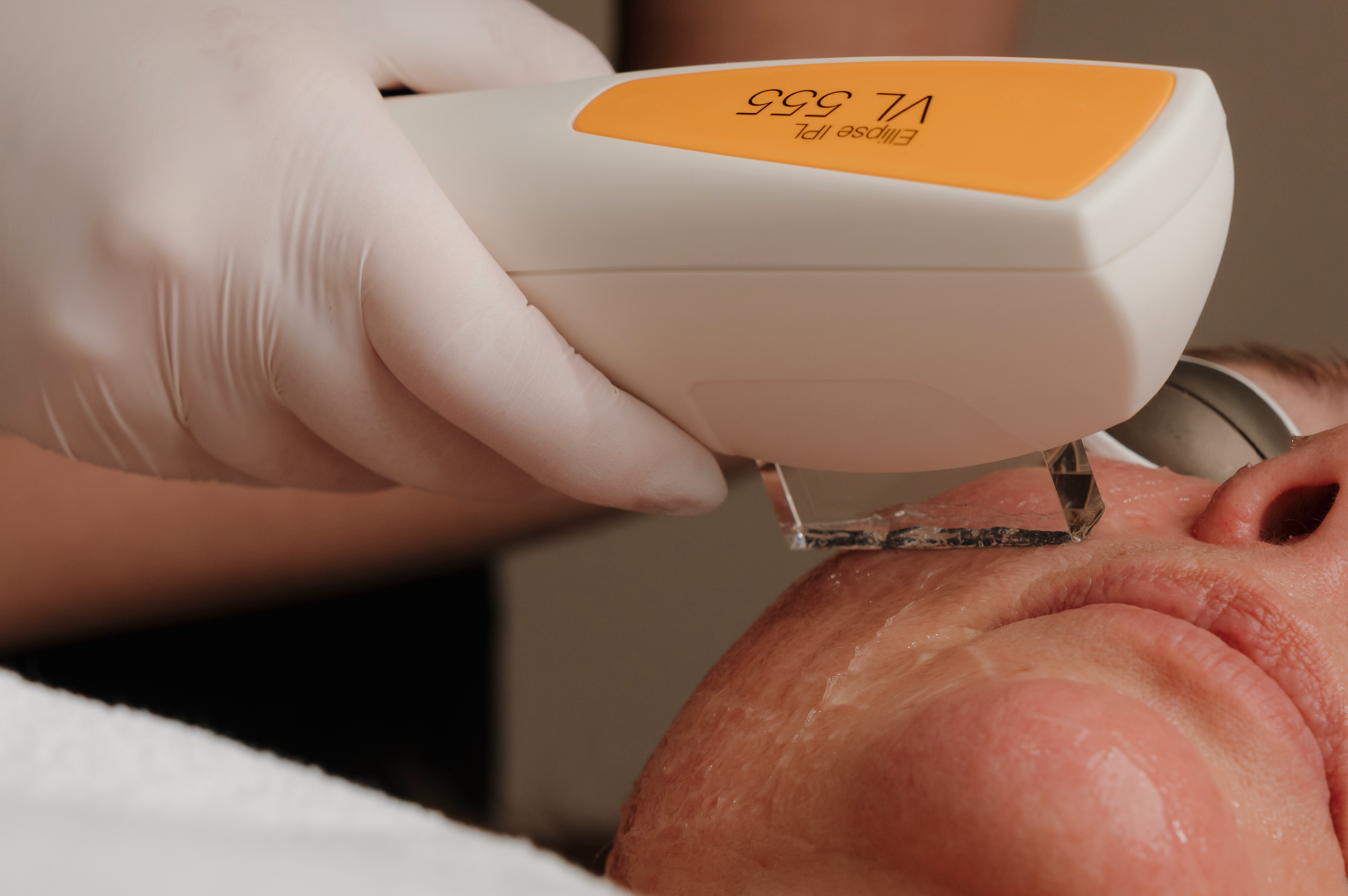 Nordlys IPL Skin Clinic Rotterdam