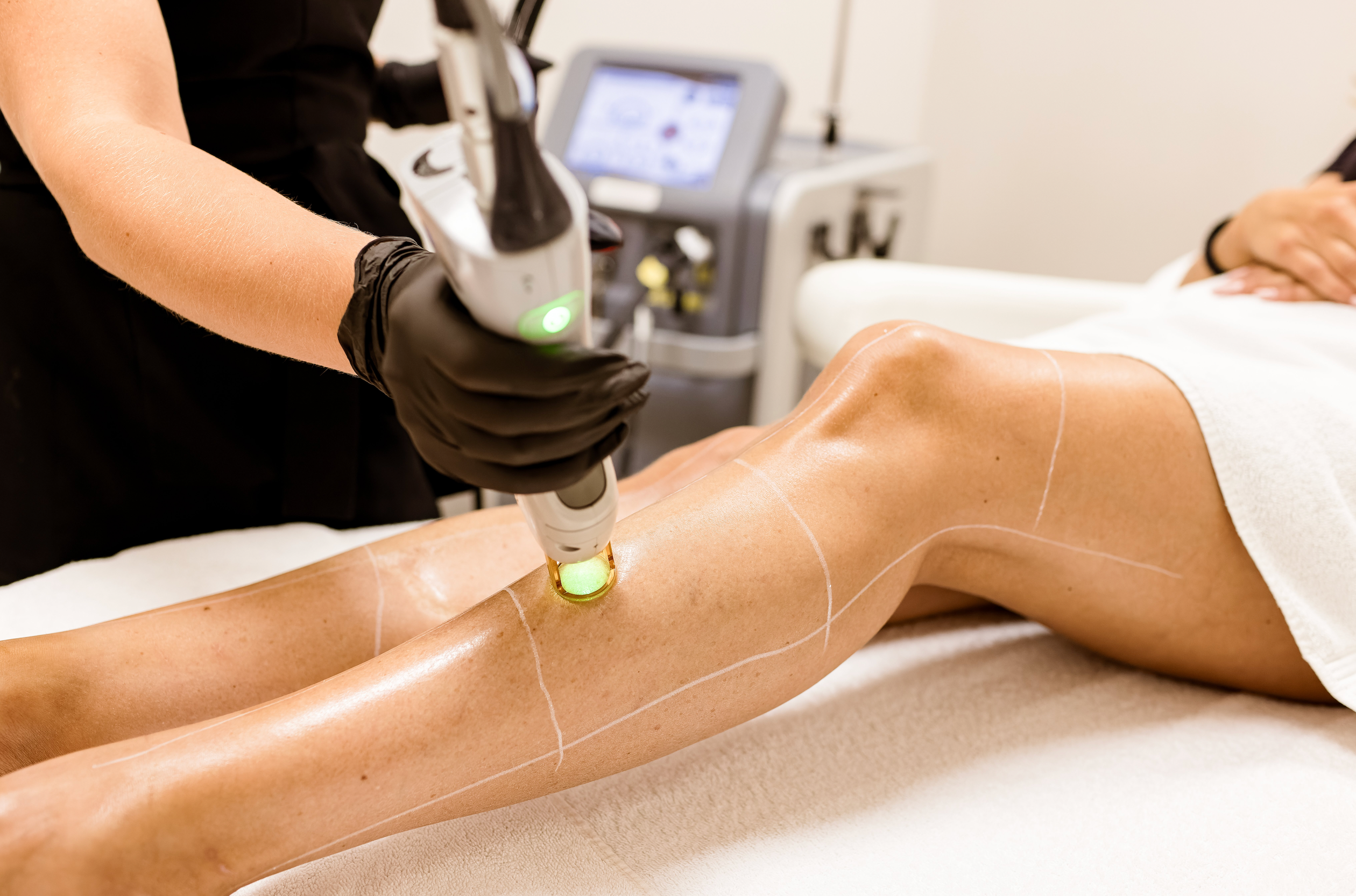 Laserontharing Gentle Max Pro Skin Clinic Rotterdam