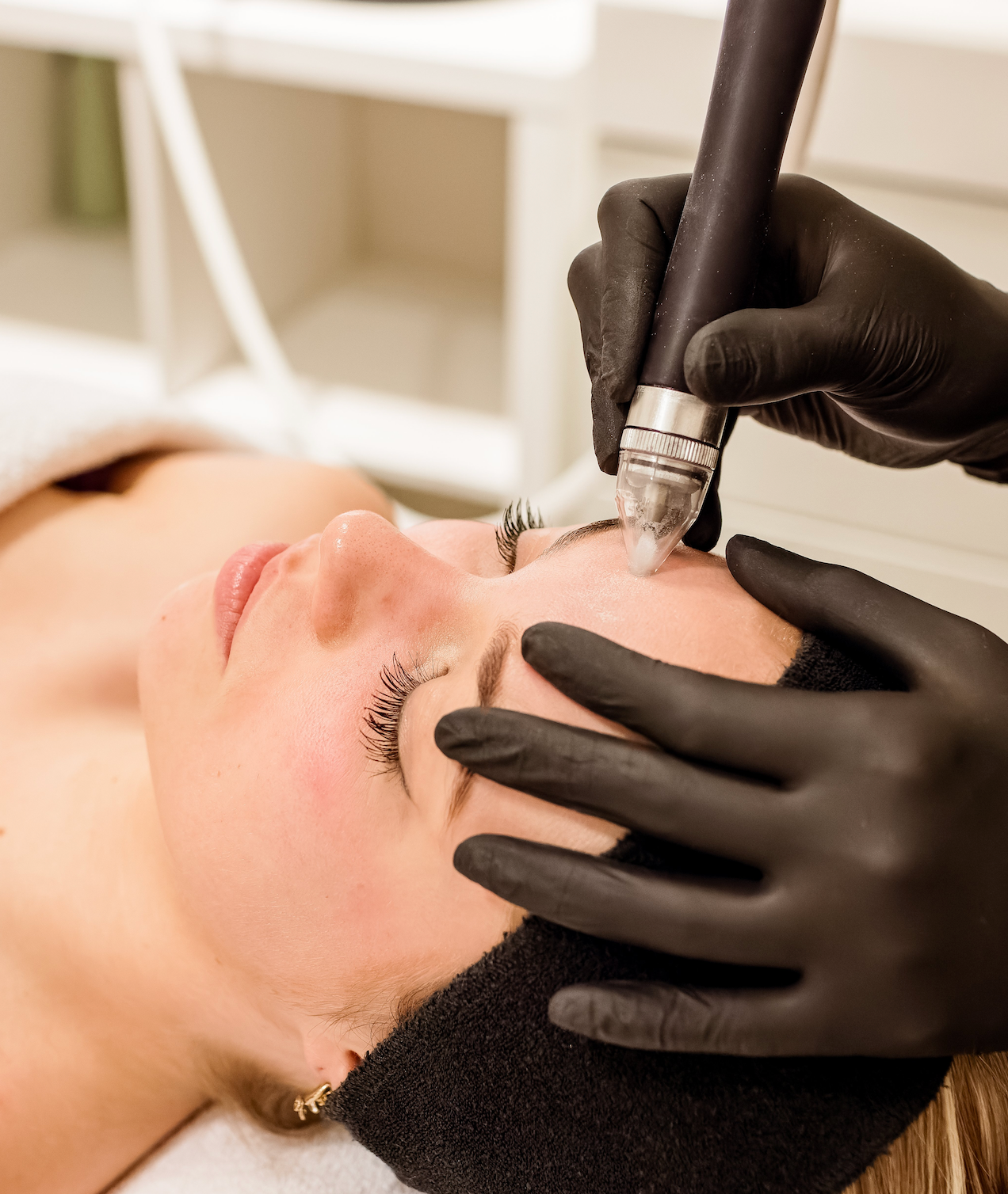 Microdermabrasie Skin Clinic Rotterdam