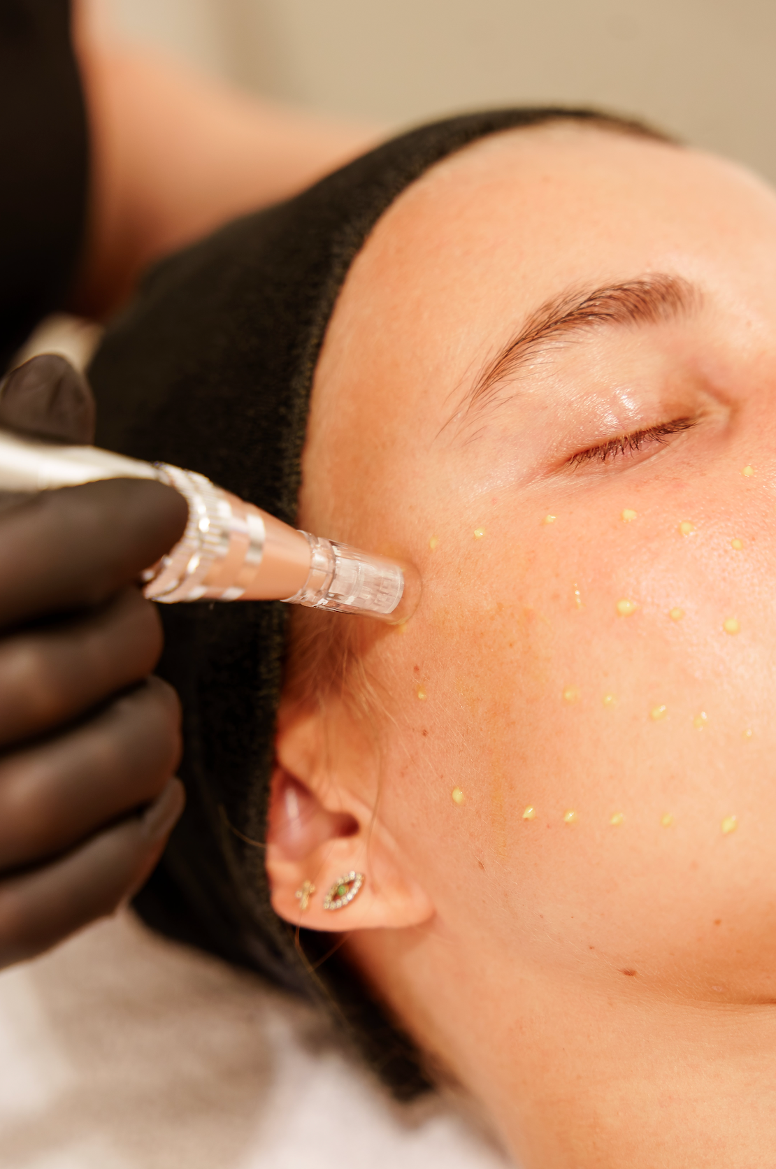 Microneedling Skin Clinic Rotterdam
