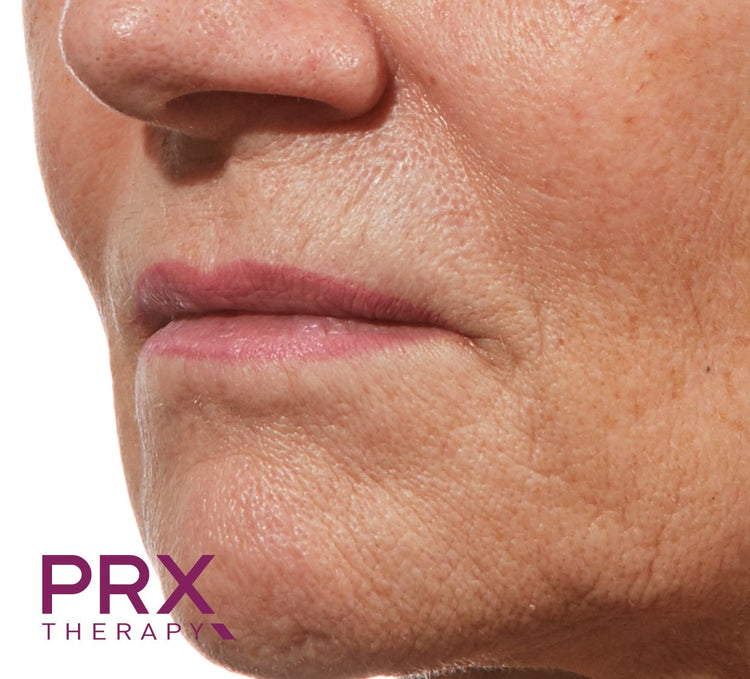 PRX-T33 voor behandeling