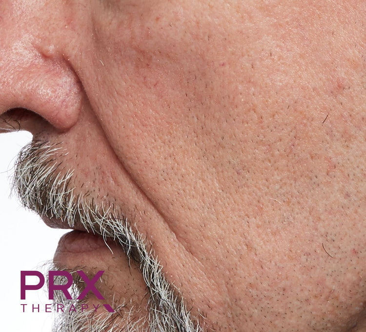 PRX-T33 voor behandeling