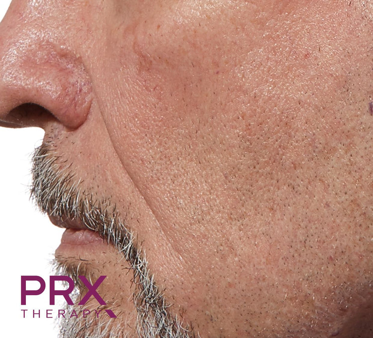 PRX-T33 na behandeling